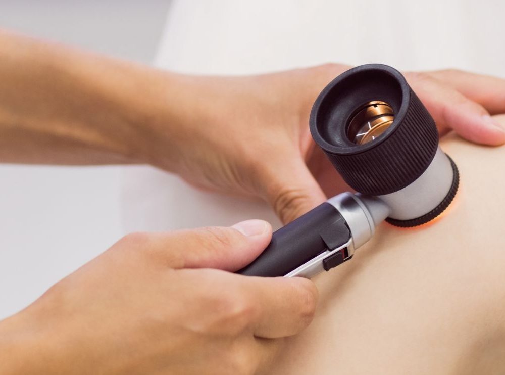 MELANOMA SZŰRŐ NAP
