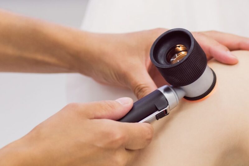 MELANOMA SZŰRŐ NAP