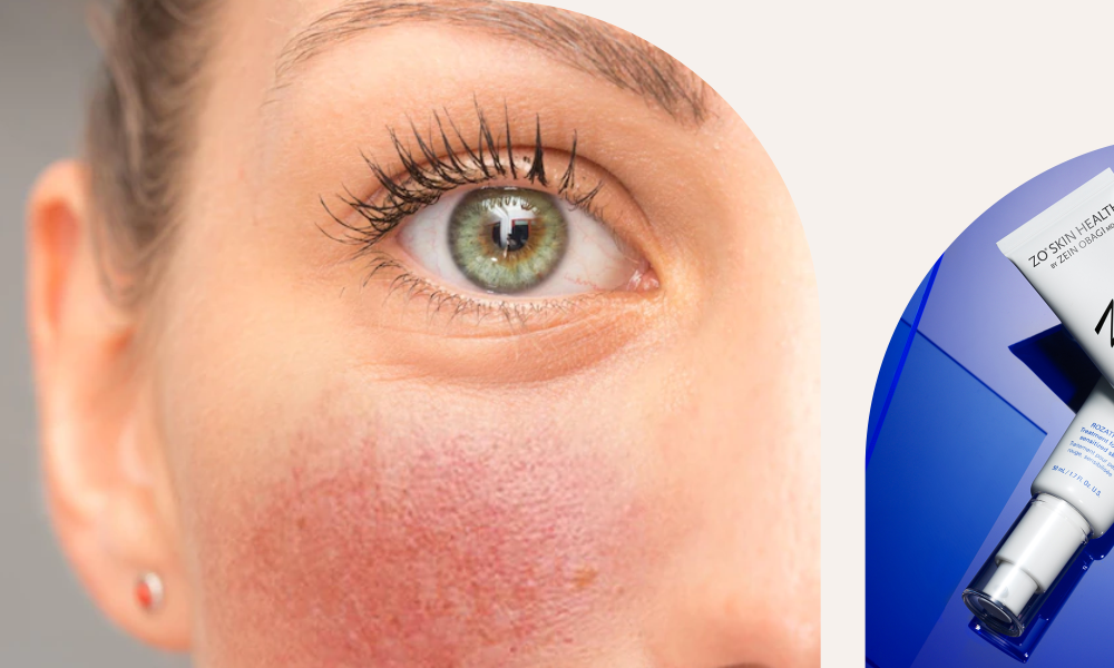 Mi a rosacea?