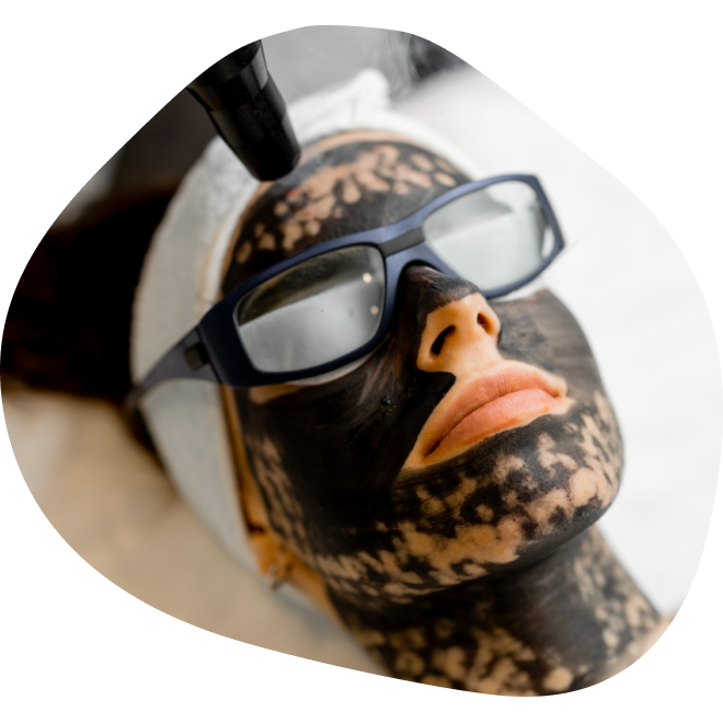 Carbon Peel