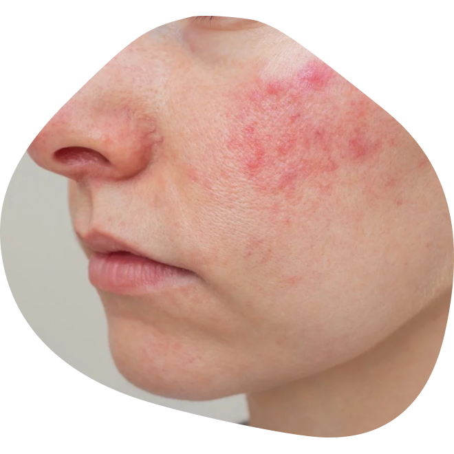 Rosacea terápia