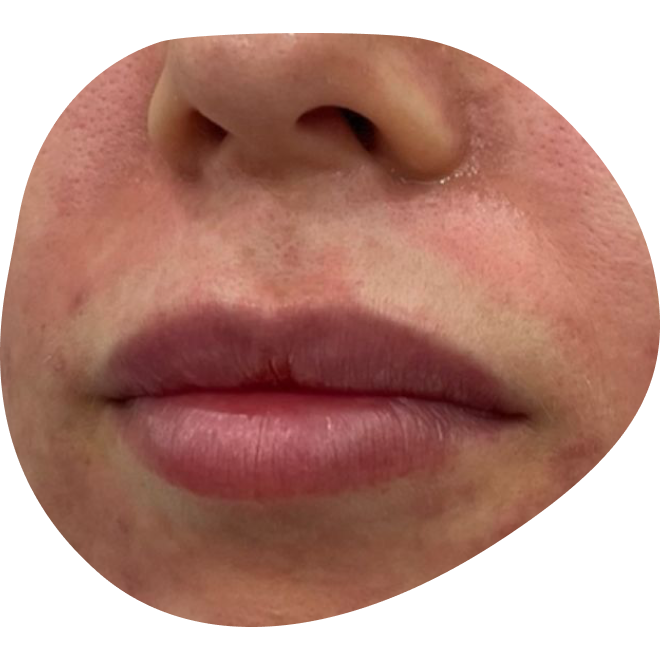 SkinPen