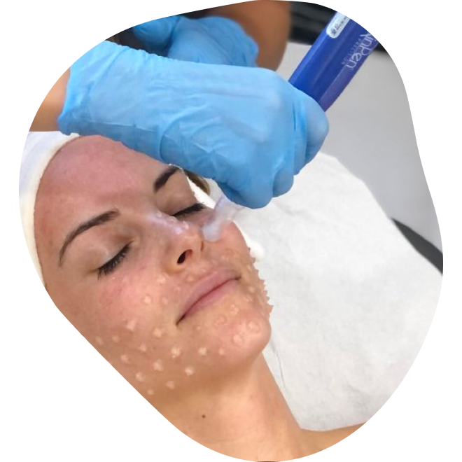 SkinPen